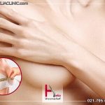هزینه عمل زیبایی ماموپلاستی