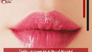 لیفت نخ لب ها به چه صورت می باشد
