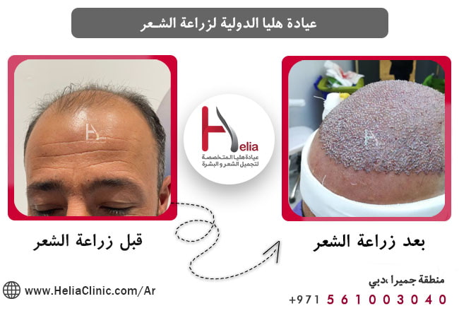 عيادة جيدة لزراعة الشعر بطريقة FUT في تركيا