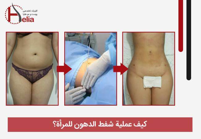 کیف عملیة شفط الدهون للمرأة