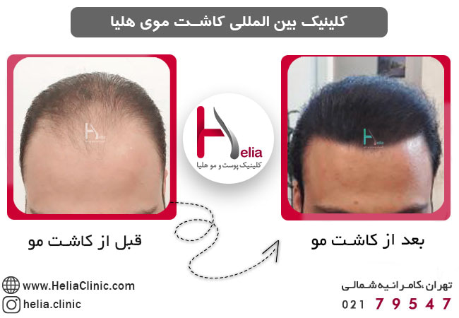 فرآیند کاشت مو به روش DHI