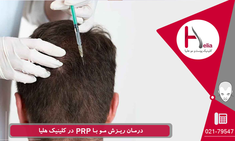 درمان موثر ریزش مو با PRP در کلینیک هلیا
