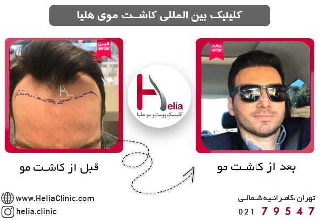قبل و بعد از کاشت مو به روش DHI