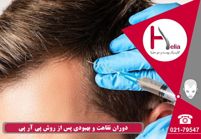 درمان انواع ریزش مو با متد prp موی سر