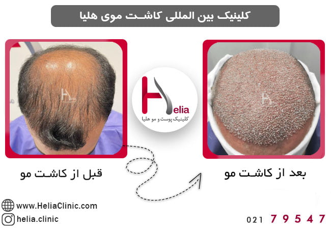 درمان ریزش مو پیشانی با کاشت مو