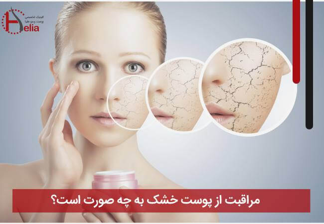 مراقبت از پوست خشک به چه صورت است؟