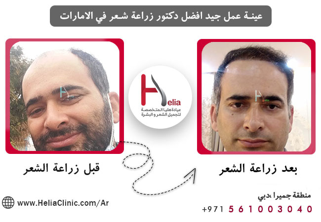 تقديم أفضل مراكز زراعة الشعر في دبي