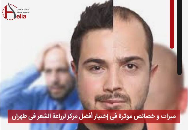میزات و خصائص موثرة فی إختیار أفضل مرکز لزراعة الشعر فی طهران