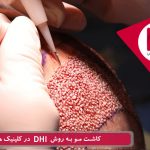 پیوند موی طبیعی به روش دی اچ آی در کلینیک هلیا