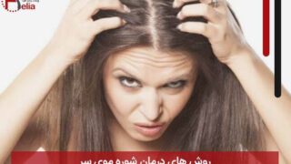 روش های درمان شوره موی سر