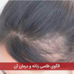 الگوی طاسی زنانه و درمان آن
