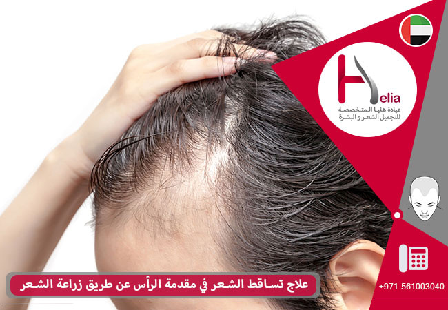 علاج تساقط الشعر فی مقدمة الرأس عن طریق زراعة الشعر