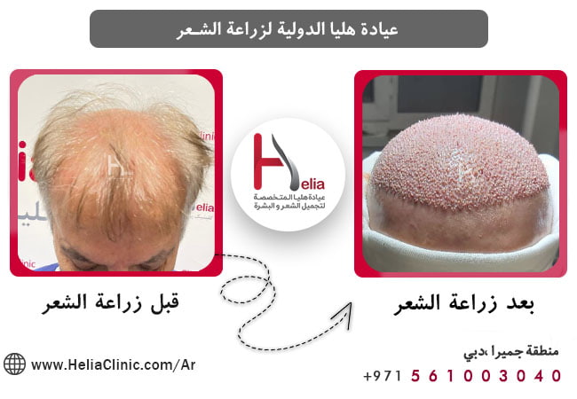 هل یمکن لکبار السن أیضًا إجراء عملیات زراعة الشعر؟