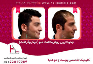 عکس کاشت مو