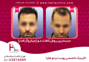عکس کاشت مو