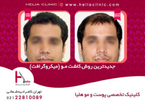 عکس کاشت مو