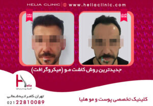 عکس کاشت مو