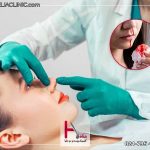 خونریزی بعد از عمل بینی
