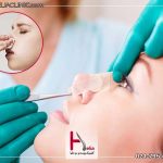 دلیل و ترشحات بینی بعد از عمل بینی