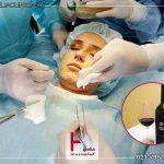 عوارض مصرف الکل بعد از عمل بینی
