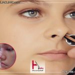 عوارض دستکاری بینی بعد از عمل بینی