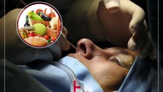 رژیم غذایی بعد از جراحی بینی