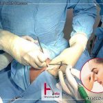 آیا جراحی بینی درد دارد
