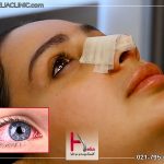 قرمزی چشم بعد از جراحی بینی
