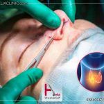 ارتباط کم کاری تیروئید برجراحی بینی
