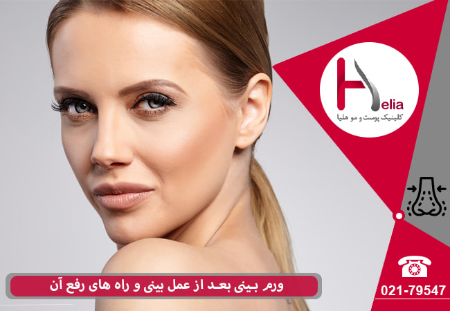 ورم بینی بعد از عمل بینی و راه های رفع آن