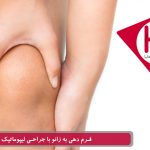 عمل لاغری زانو