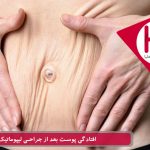 افتادگی پوست بعد از جراحی لیپوماتیک