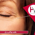 بوتاکس یا تزریق ژل