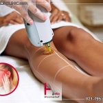 آیا لیزر موهای زائد با درد دارد