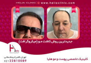 عکس کاشت مو