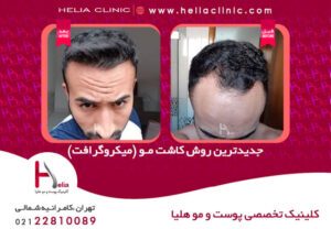 عکس کاشت مو