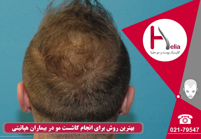 روش مناسب برای کاشت مو در بیماران مبتلا به هپاتیت