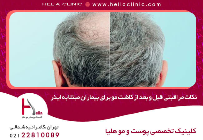 نکات مراقبتی قبل و بعد از کاشت مو برای بیماران مبتلا به ایذر