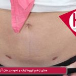 جای زخم لیپوماتیک و نحوه در مان آن