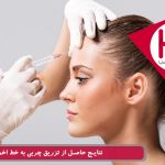 نتایج حاصل از تزریق چربی به خط اخم