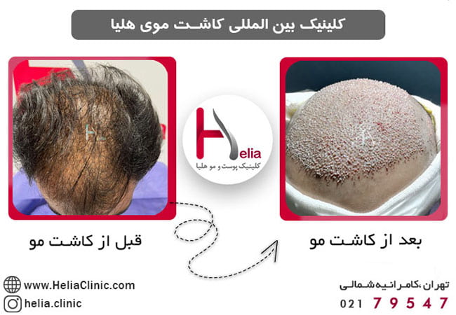 (The latest hair transplant method in Iran (micrograft