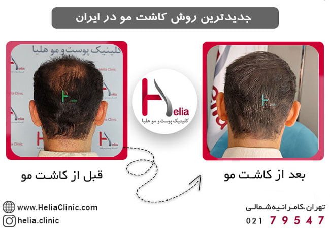 The latest hair transplant method in Iran and the world
