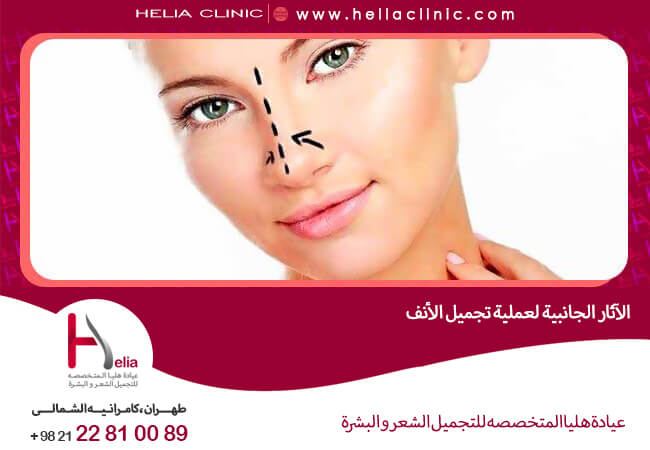 هل ثقل الأنف بعد عملية تجميل الأنف أمر طبيعي کلینیک هلیا