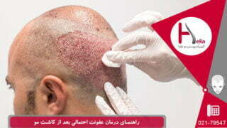 راهنمای درمان عفونت احتمالی بعد از پیوند مو