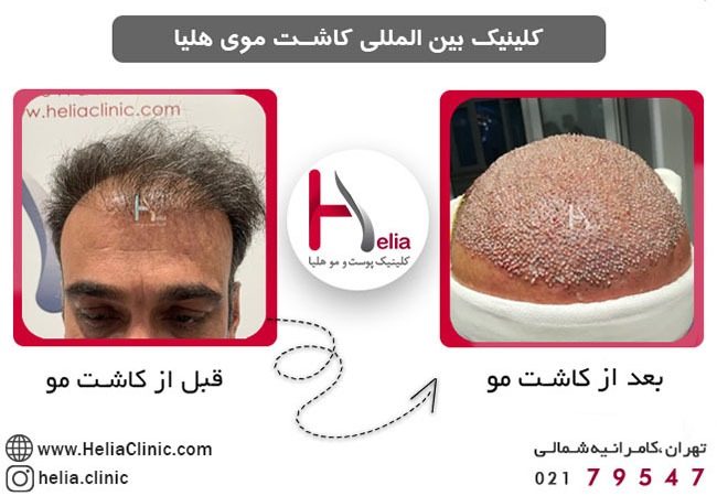 عکس قبل و بعد جدیدترین روش کاشت مو در ایران