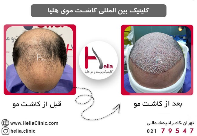 عکس قبل و بعد از کاشت مو از بغل