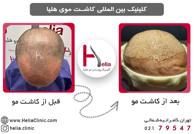 عکس قبل و بعد از کاشت مو از بالا