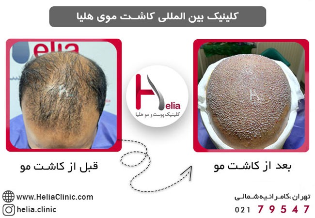 روش دی اچ آی (Direct Hair Implantation)
