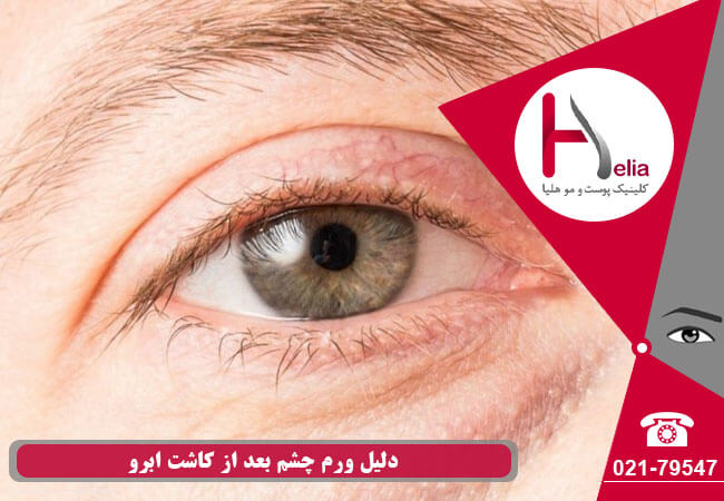 The reason for eye swelling after eyebrow implantation