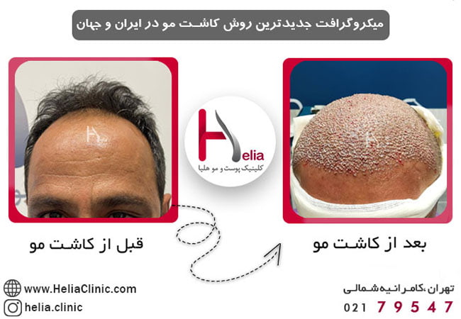 میکروگرافت جدیدترین روش کاشت مو در ایران و جهان